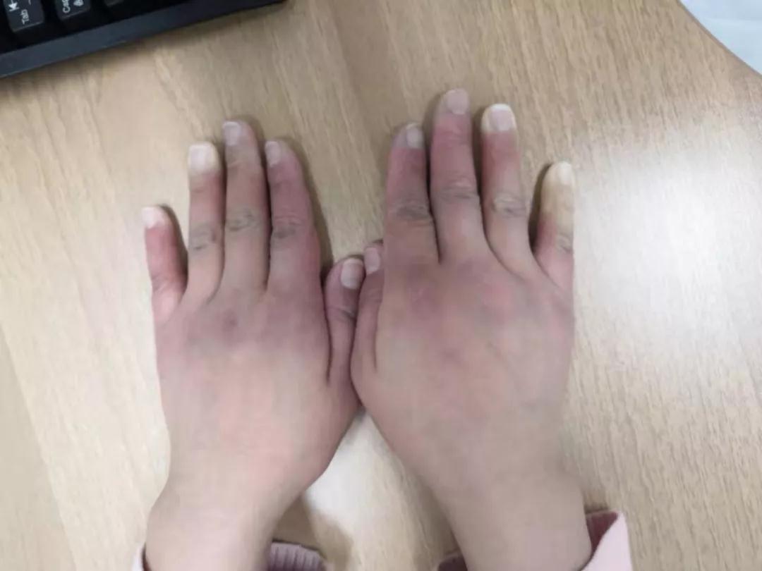“手指、腳趾發(fā)白、發(fā)紫……”這些“小毛病”千萬(wàn)別大意