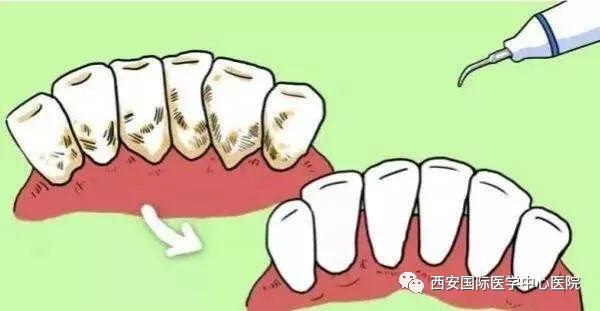 牙齒上的黃斑好難看，三招告訴你如何預防氟斑牙