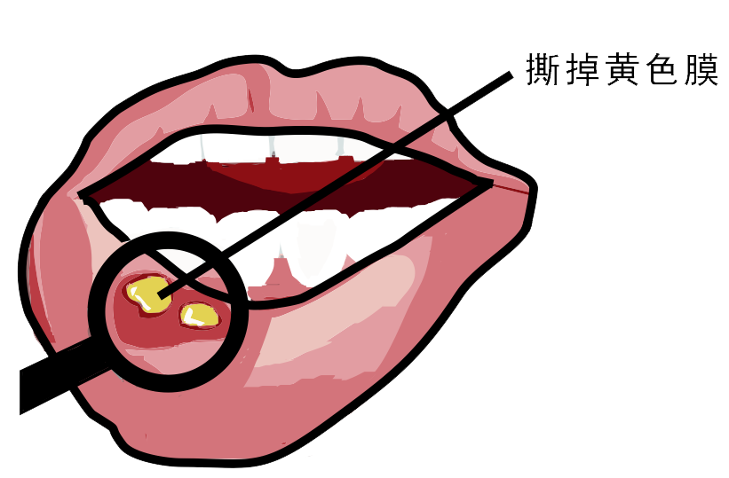 經(jīng)常口腔潰瘍，真的只是缺維生素嗎？