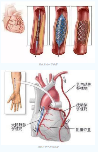 魚與熊掌不可兼得？冠脈雜交手術(shù)一站式解決問題