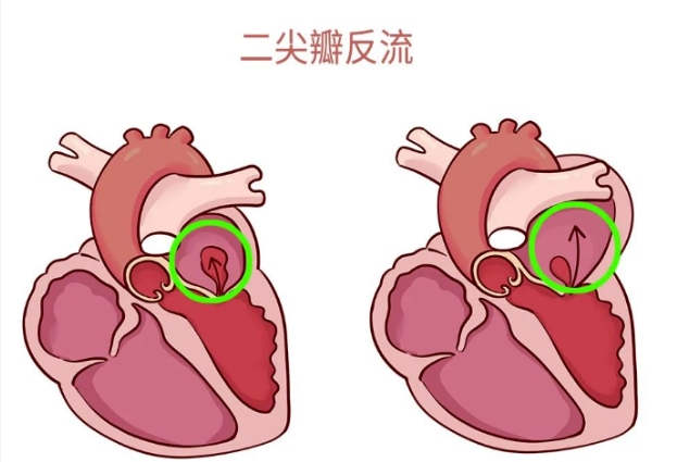 體檢報告里的心臟瓣膜返流，你讀懂了嗎？