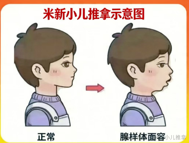 兒童腺樣體肥大只能手術(shù)？不，一位媽媽的親身經(jīng)歷給出另一種答案
